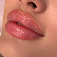 تزریق ژل لب گونه چانه زاویه فک خط خنده فقط ۵۰۰