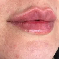 اموزش ژل و بوتاکس