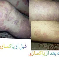 درمان قطعی وبدون بازگشت پوستی