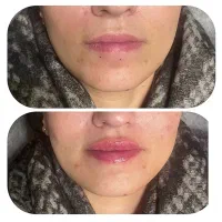 تزریق ژل و بوتاکس