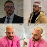 کاشت مو تیم شیراز و مشهد در یزد (تضمینی و اقساطی)|خدمات آرایشگری و زیبایی|یزد, |دیوار