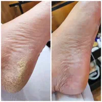 پدیکور کفسابی پا کاملا تخصصی ،تخفیف باورنکردی ۳۴۹