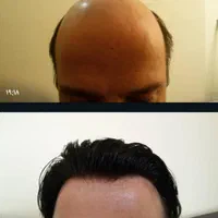 پروتز مو و ترمیم موی شقایق. چسب پروتز|خدمات آرایشگری و زیبایی|تبریز, |دیوار