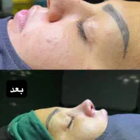جراحی بینی با فوق تخصص پلاستیک فقط ۵۵میلیون|خدمات زیبایی و سلامت|تهران, قبا|دیوار