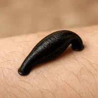 فروش زالو درمانی