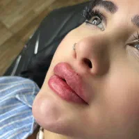 اف بوتاکس و فیلر از ۷۵۰ تومان