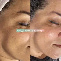 فیشیال تخصصی و درمانی فقط تا۹شهریور تخفیف داره|خدمات آرایشگری و زیبایی|مشهد, هنرستان|دیوار