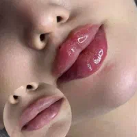 ژل /بوتاکس /سابسیژن در مشهد