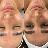 پاکسازی تخصصی پوست و مو و هایفو و خالبرداری