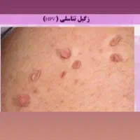 برداشتن زگیل تناسلی با قیمت پایین|خدمات آرایشگری و زیبایی|محمدیه-قزوین, |دیوار
