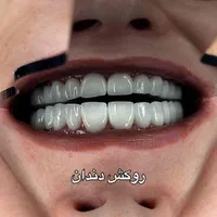 کامپوزیت دندان لمینت عصب کشی دندانپزشکی بوتاکس|خدمات آرایشگری و زیبایی|کرج, فاز ۱ مهرشهر|دیوار