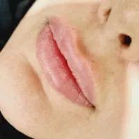 ژل بوتاکس مزونیدلینگ صورت مزوتراپی زیرچشم