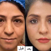 بلفاروپلاستی پلک|خدمات آرایشگری و زیبایی|تهران, یوسف‌آباد|دیوار