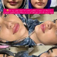 لب زیرچشم نورامیس لیزر بلفارو غبغب