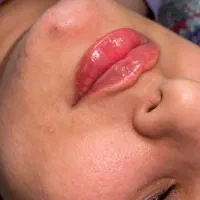ژل و بوتاکس|خدمات آرایشگری و زیبایی|مشهد, طلاب|دیوار