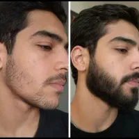با کم پشتی ریش و سیبیلات خداحافظی کن