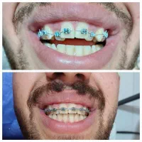 دندانپزشکی.کامپوزیت.ارتودنسی.روکش.عصبکشی|خدمات آرایشگری و زیبایی|کرمانشاه, |دیوار