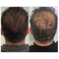 برای پرپشت شدن ریش و موهات اقدام کن
