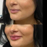 تزریق ژل و بوتاکس