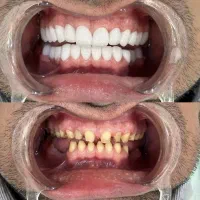 کاشت ایمپلنت حرفه ای با ضمانت + اقساط ویژه