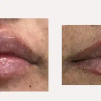 مدل فیلر صورت در کلینیک نوا|خدمات آرایشگری و زیبایی|شیراز, ستارخان|دیوار
