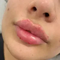 تزریق انواع فیلر (ژل )بوتاکس وخدمات میکروپیگمنتیشن|خدمات آرایشگری و زیبایی|یاسوج, |دیوار