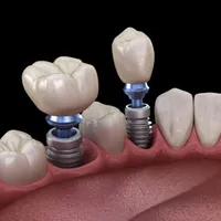 دندانپزشکی ایمپلنت زیبایی اقساطی