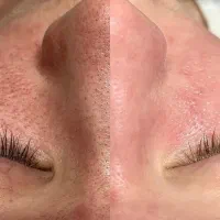 /انالیز/ مزوتراپی/ پی آر پی /پاکسازی پوست