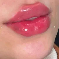 تزریق ژل وبوتاکس|خدمات آرایشگری و زیبایی|شیراز, ریشمک|دیوار