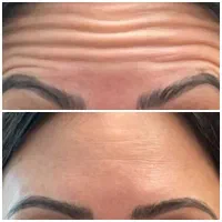 بوتاکس کل صورت