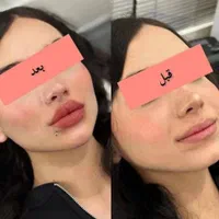 جشنواره مدلینگ ۱۰ سی سی امروز۳۳۰۰فیلر لب لیفت ابرو|خدمات آرایشگری و زیبایی|تهران, مرزداران|دیوار