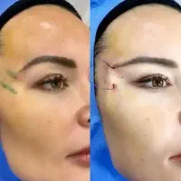 ژل و بوتاکس کاشت ابرو قسطی|خدمات آرایشگری و زیبایی|یاسوج, |دیوار