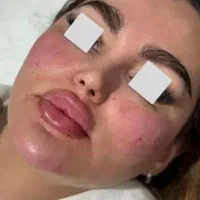 خدمات تزریق چربی ، ژل، بوتاکس، فیلر بادی|خدمات آرایشگری و زیبایی|قم, پردیسان|دیوار