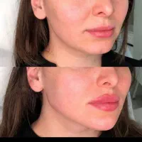 پوست سفید فیلر بوتاکس