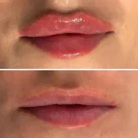 مطب پزشک ژل لب گونه چونه زاویه فک بوتاکس فیلر بینی|خدمات آرایشگری و زیبایی|قم, صفائیه|دیوار