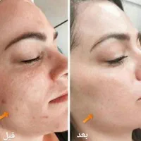 ۸۰درصد تخفیف در/لیزر/مزوتراپی/prp/جوانساز