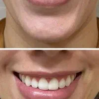 بمب تخفیف ژل و بوتاکس|خدمات آرایشگری و زیبایی|بندر امام خمینی, |دیوار