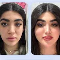 مادلینگ کل صورت (فیلر اورجینال)