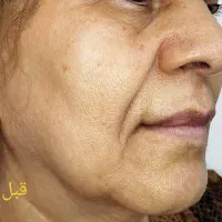 لیفت وجوانسازی قوی صورت|خدمات آرایشگری و زیبایی|رشت, گلسار|دیوار