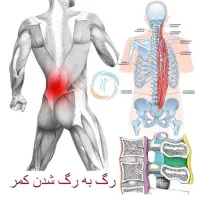 راهنمای واس دیسک کمر و رگ سیاتیک و گرفتگی غضلات