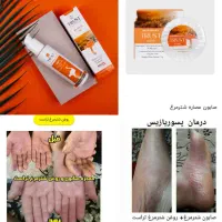 درمان پسوریازیس