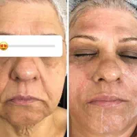 هایفوتراپی جوانسازی آف ویژه