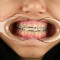 اقساط دندان ونیر کامپوزیت روکش لمینت ایمپلنت ترمیم|خدمات آرایشگری و زیبایی|مشهد, سجاد شهر|دیوار