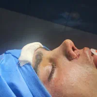 جراحی بینی توسط دکتر متخصص امیر اسدالله پور|پزشکی|قائمشهر, |دیوار