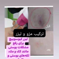 ژل بدن وصورت آموزش  تزریق دراهواز|خدمات آرایشگری و زیبایی|اهواز, کیانپارس |دیوار