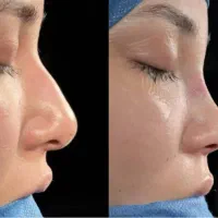 عمل بینی 23تا25/مشاوره رایگان