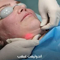 اندولیفت/ جوانسازی /تخلیه چربی صورت / رفع سلولیت|خدمات آرایشگری و زیبایی|تهران, صادقیه|دیوار