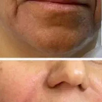 تزریق ژل و بوتاکس|خدمات آرایشگری و زیبایی|بندر کنگان, |دیوار