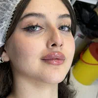 تزریق ژل بوتاکس هایفوتراپی بلفاروپلاستی توسط پزشک