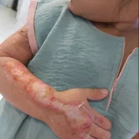 پماد سوختگی دست و پا|آرایشی، بهداشتی، درمانی|شیراز, لشکری‎|دیوار